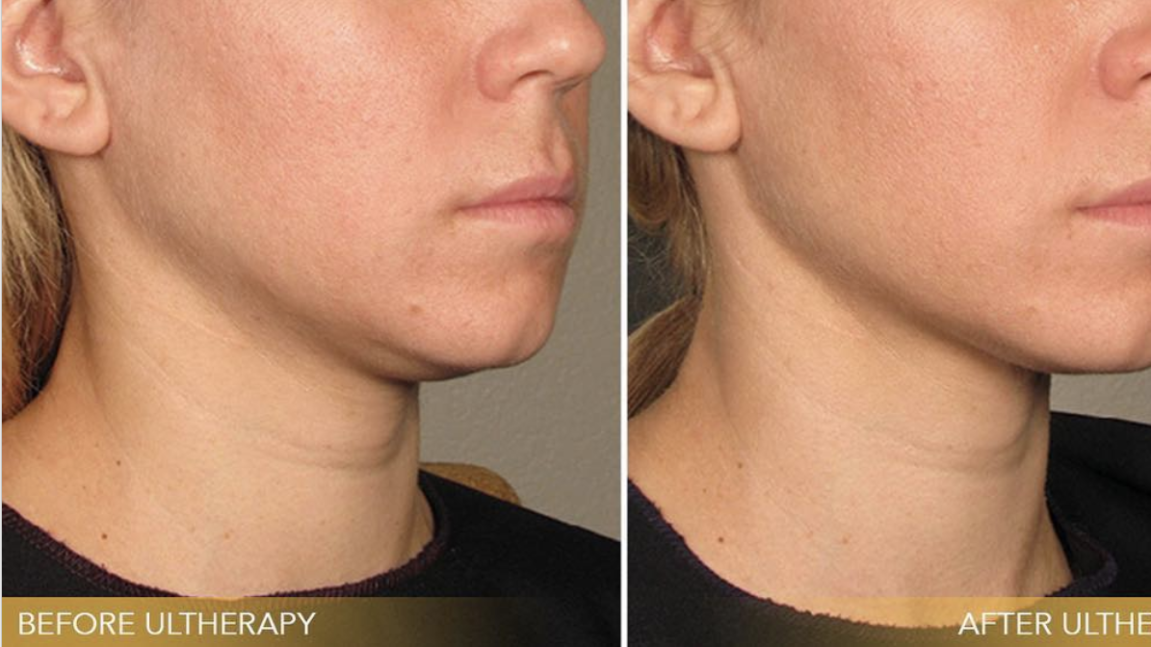 Ultherapy：一种非侵入性提拉紧致皮肤的治疗方法