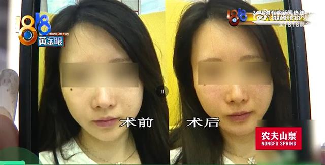 被“恋恋桃花眼”等众多新名词忽悠！女子称花12万整形反老了10岁，又花数万元恢复凹凸脸